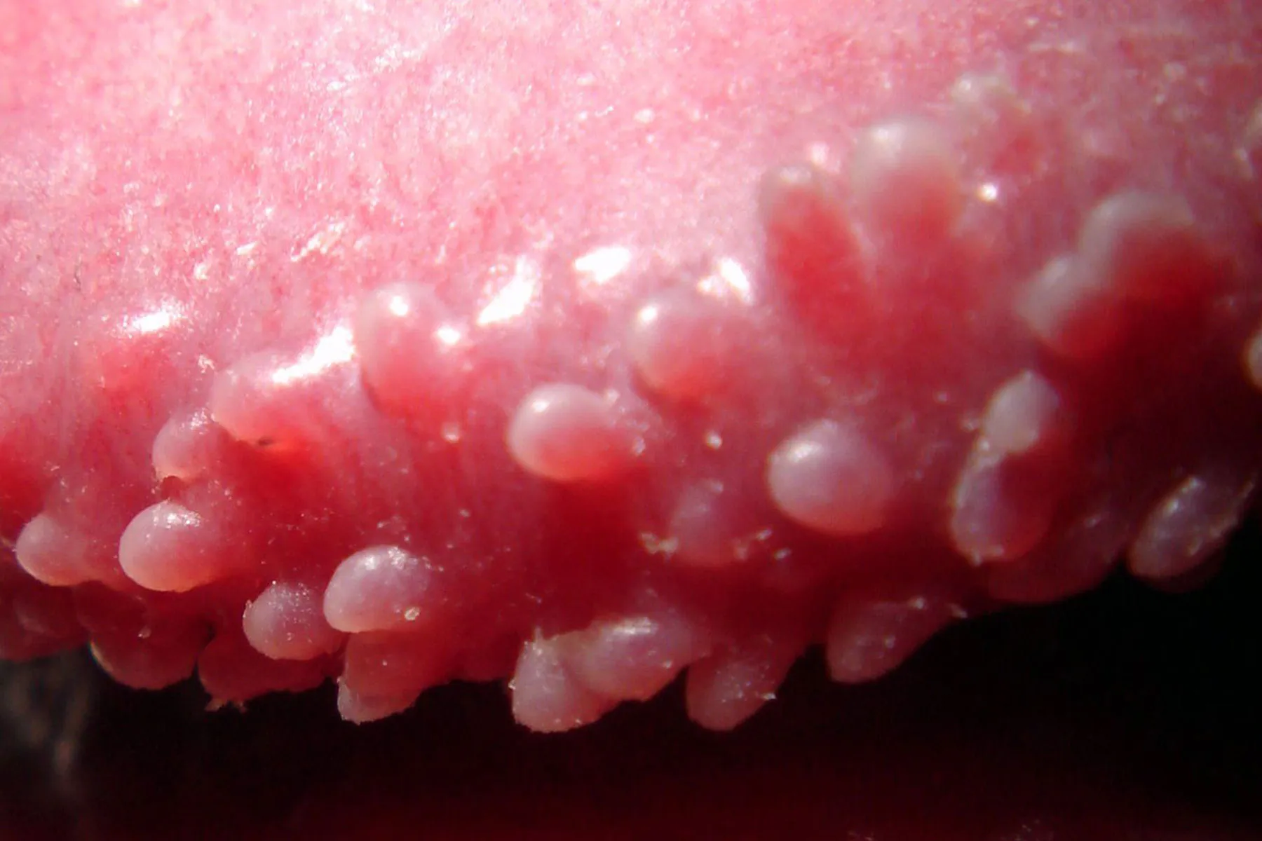 Penile Papules: What Are They and How Do They Impact Your Health?