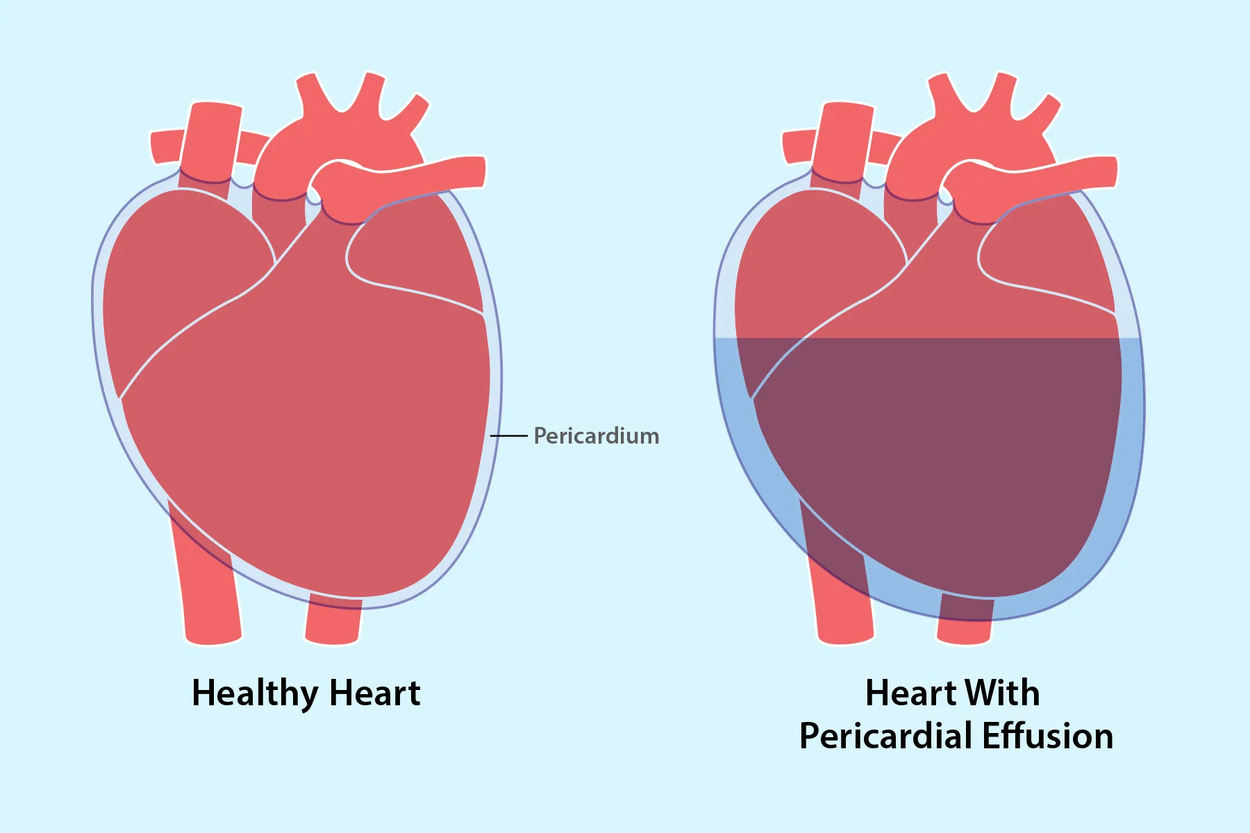 photo of pericardial effusion