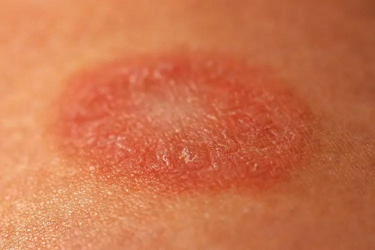 photo of Pityriasis Rosea