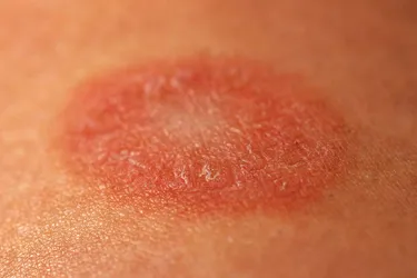 Pityriasis rosea can be diagnosed with a biopsy or a blood test. (Photo credit: Mila722/Dreamstime)