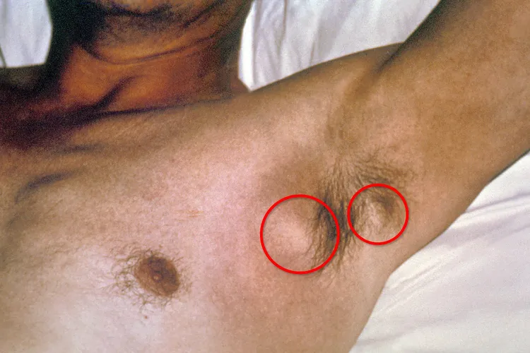 photo of axillary bubos on plague patient