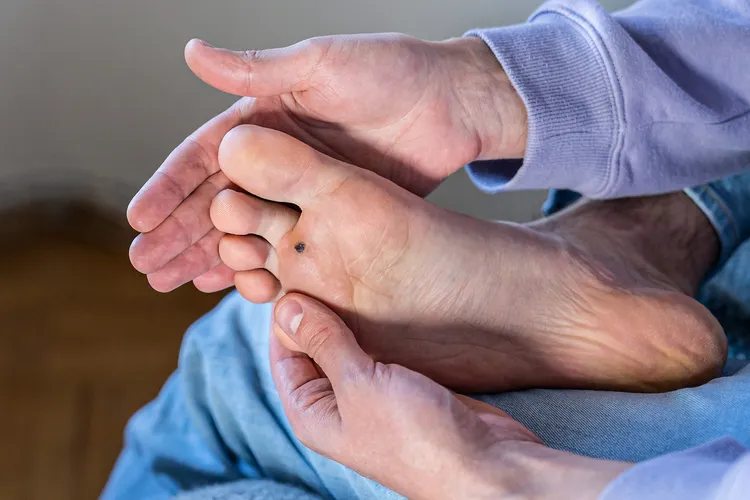 photo of Man checks foot wart