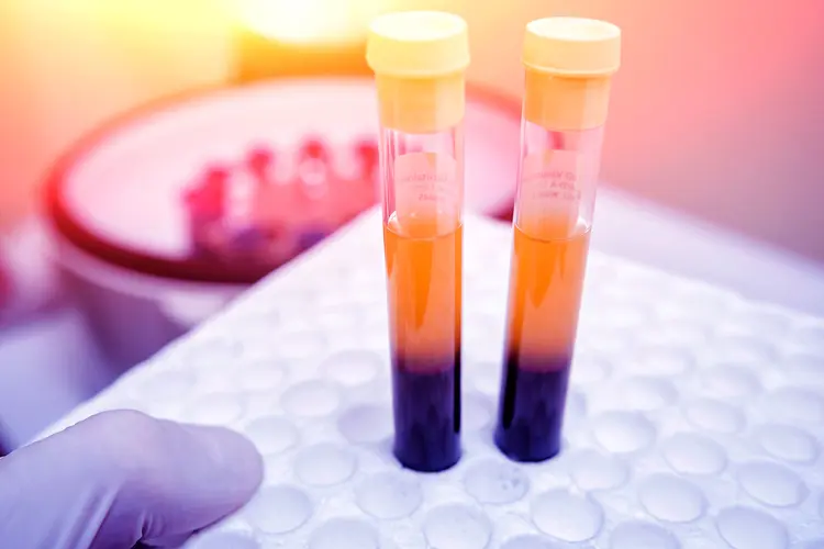 photo of Platelet-Rich plasma preparation