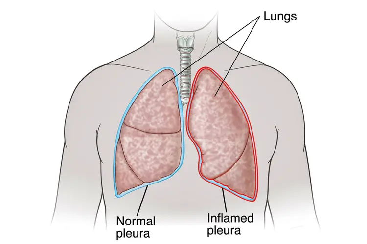 photo of Front view of lungs showing pleurisy.