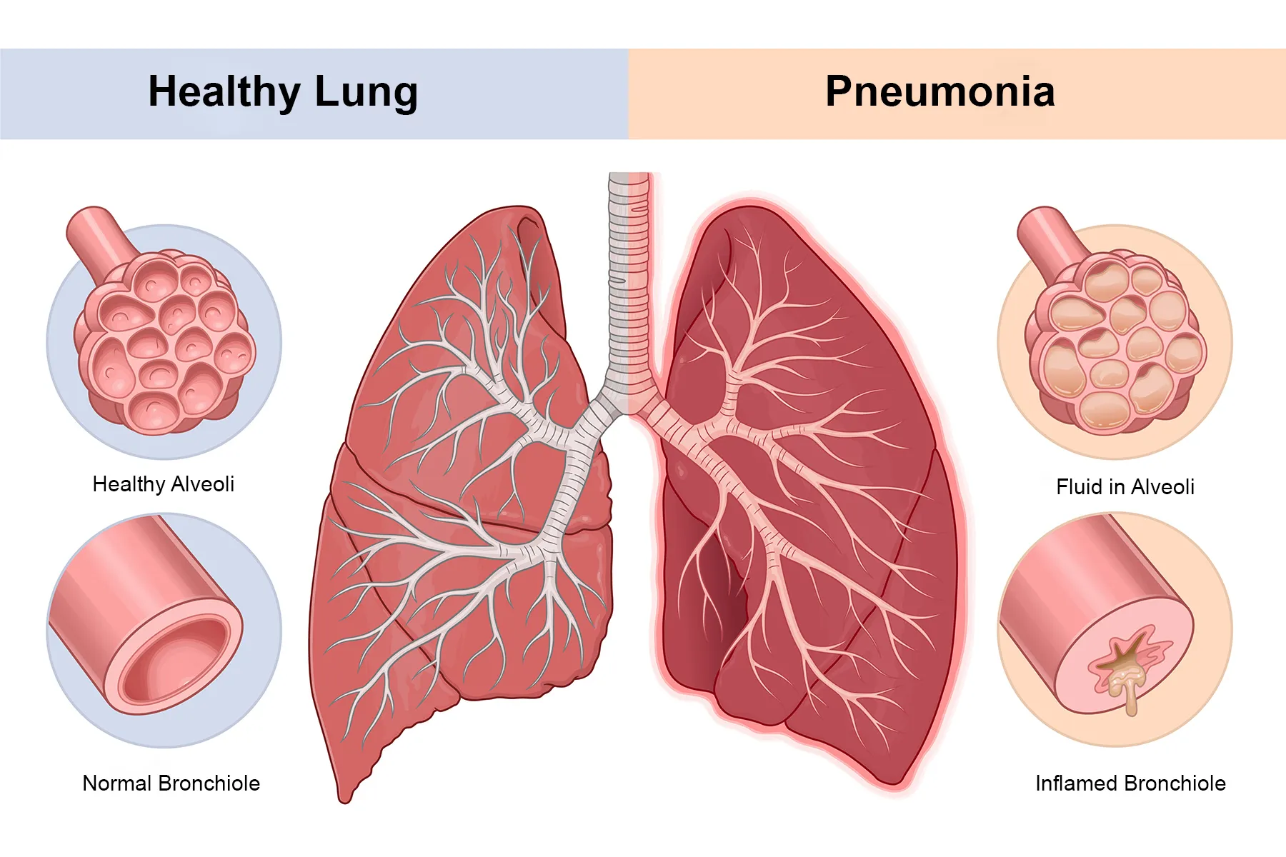 Pneumonia Cases Rise Across UK As Experts Outline Causes And Risks