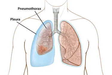 Pneumothorax or collapsed lung can happen for many different reasons. Usually, it won't have long-term effects on your health, but it's important to get treatment right away, as it can be life-threatening. (Image Credit: Anna Kuo)
