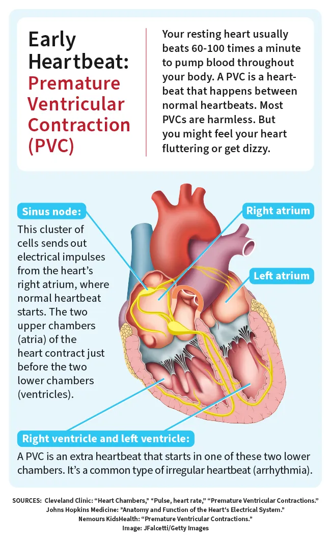 photo of Premature Ventricular Contractions