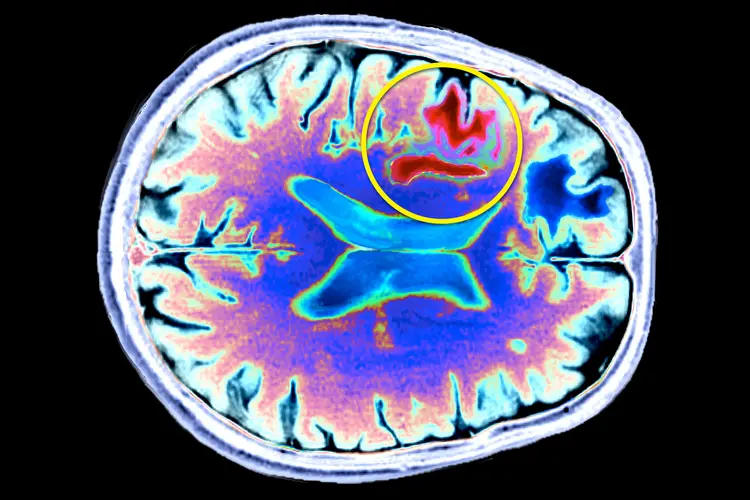 photo of progressive multifocal leukoencephalopathy