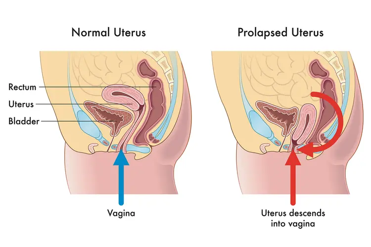 photo of a prolapsed uterus