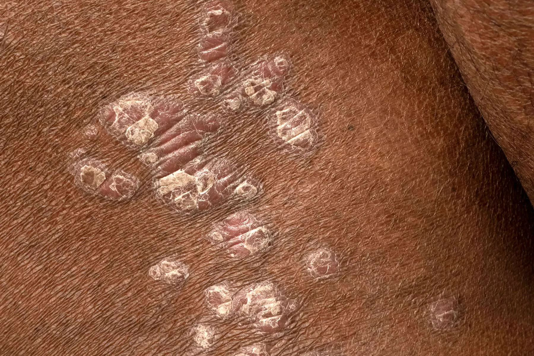 photo of psoriasis on patient's torso