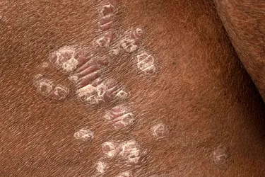 If your skin tone is darker, your plaques may be more of a purple color, and your scales gray. (Photo Credit: SCIENCE PHOTO LIBRARY/Science Source)