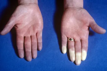 During a Raynaud's attack, your fingers, toes, or other body parts will get cold and your skin turns white and blue, varying based on your skin tone. (Photo Credit: St Bartholomew's Hospital/Science Source)