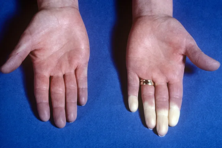 During a Raynaud's attack, your fingers, toes, or other body parts will get cold and your skin turns white and blue, varying based on your skin tone. (Photo Credit: St Bartholomew's Hospital/Science Source)