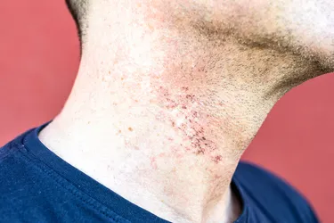 Razor burn might last only a few hours after shaving, or your skin could remain irritated for a few days. (Photo credit: Mheim301165/Dreamstime)