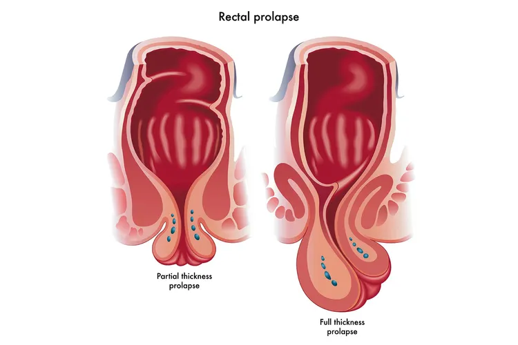 photo of Rectal prolapse