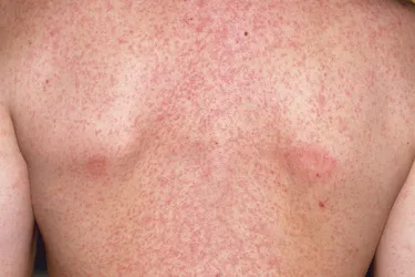 Rubella?is a contagious infection that mostly affects children and causes symptoms like a?rash,?fever, and?eye?redness. It’s usually mild in kids but can be serious in people who are?pregnant?and in unborn babies. The best means of protection is to get vaccinated with the?measles,?mumps, and rubella (MMR)?vaccine. (Photo credit: Allan Harris/Medical Images)