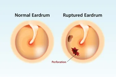 You get a ruptured eardrum when you get a tear or hole in your eardrum, most commonly from a bad middle ear infection. (Photo Credit: iStock/Getty Images)