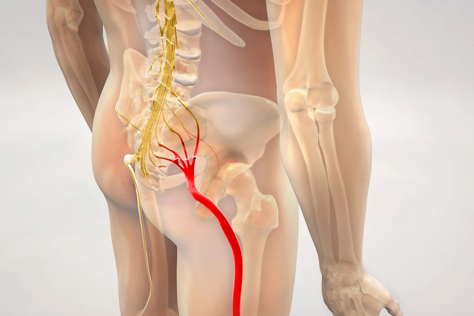 photo of pinched sciatic nerve