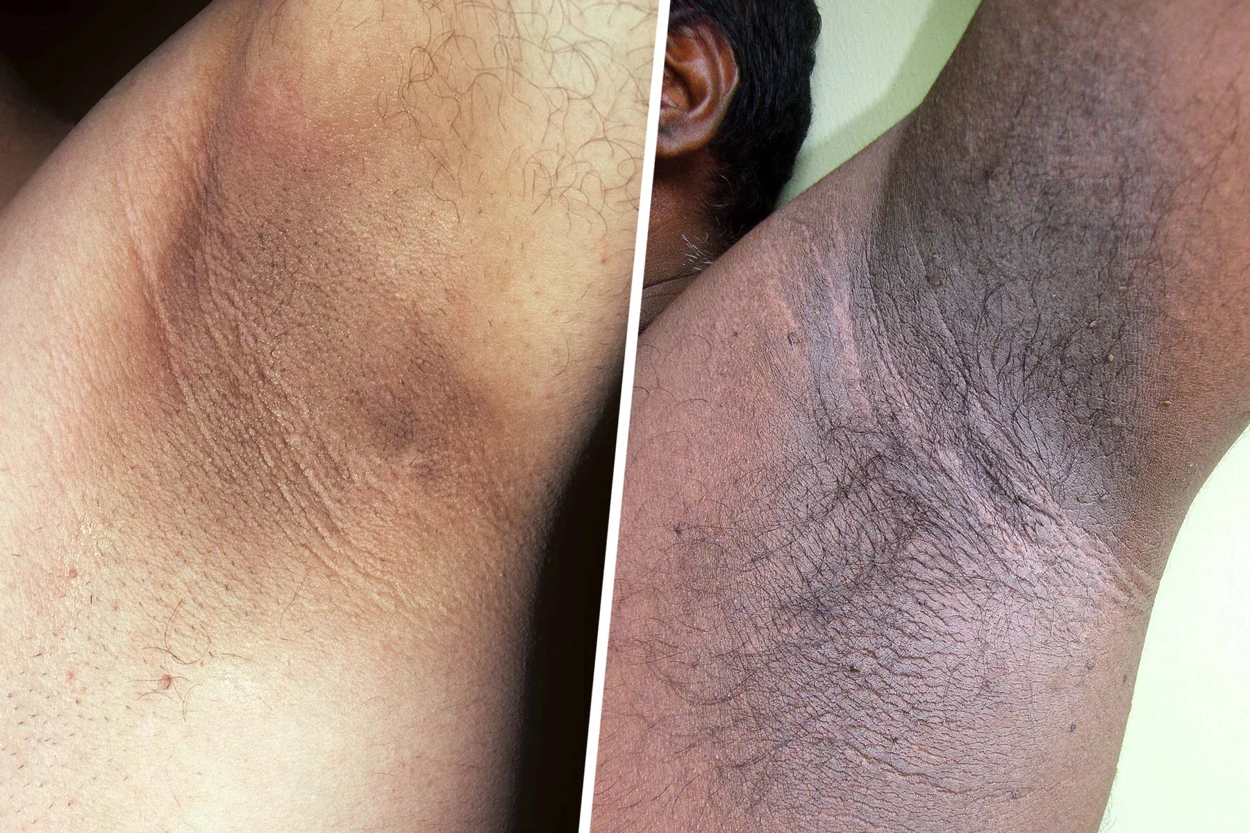 photo of comparison of Acanthosis nigricans on skin types