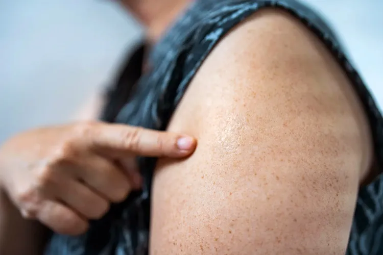 photo of vaccine scar