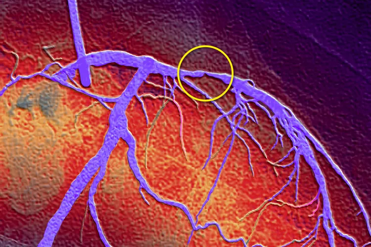 Smoke inflames the cells that line your blood vessels. Over time, the vessels can narrow, which can lead to heart problems. (Photo Credit: PDSN/Medical Images)