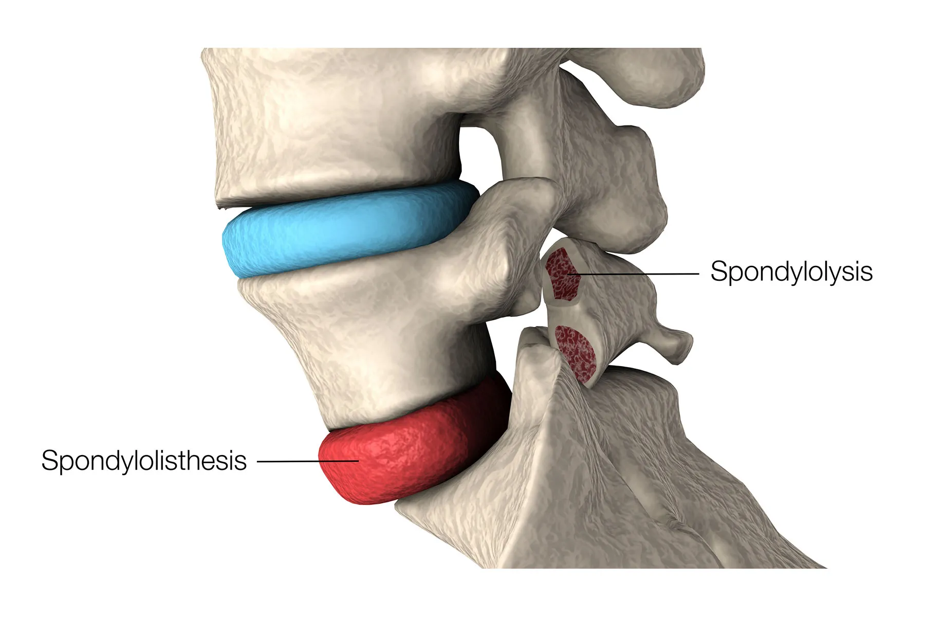 photo of spondylolisthesis 