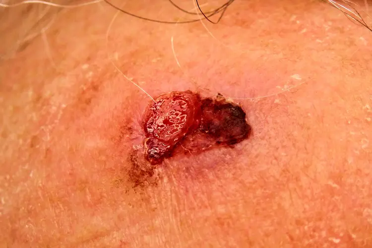 photo of squamous cell carcinoma
