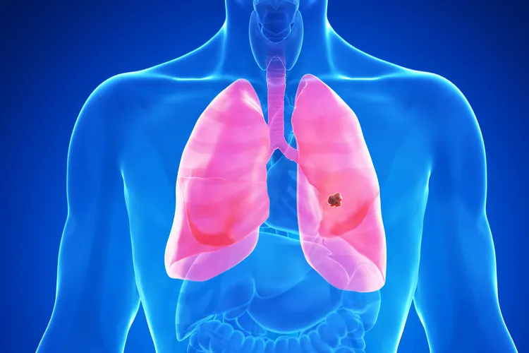 photo of Stage 1 lung cancer