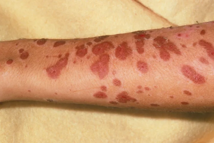 photo of Stevens-Johnson Syndrome rash