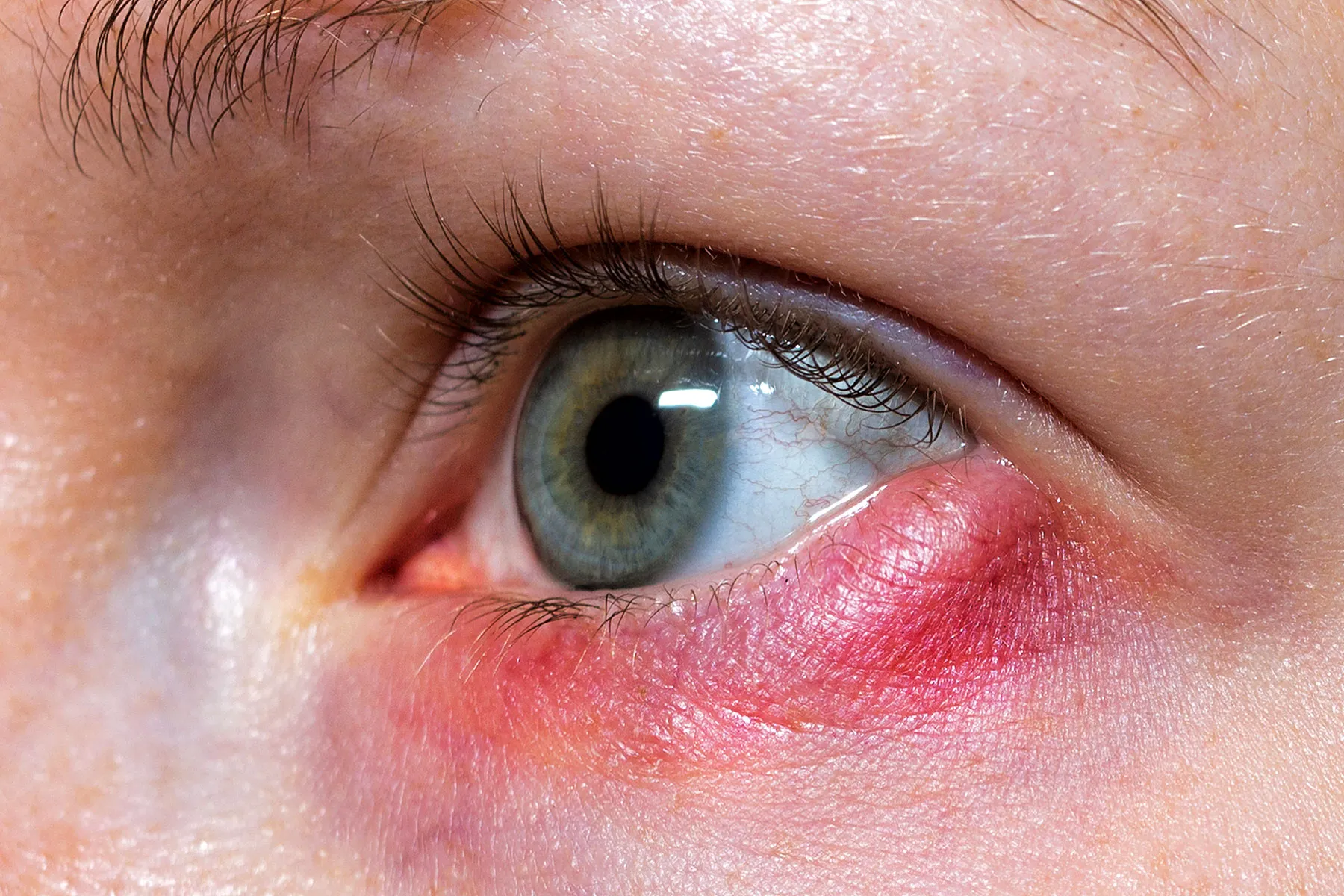 photo of Stye on the girl`s eye