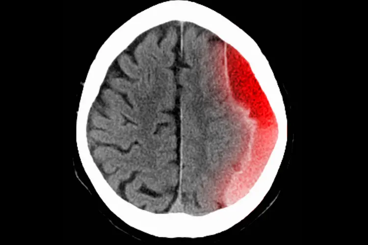 photo of subdural hematoma 