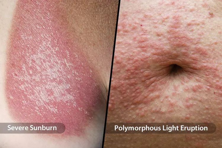 photo of two sun poisoning symptoms