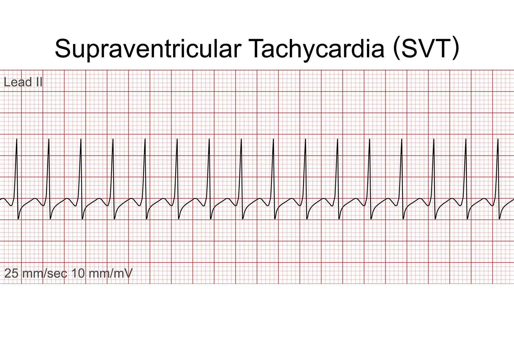 photo of Supraventricular tachycardia SVT