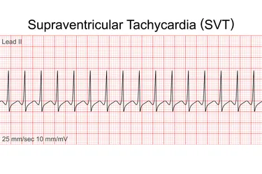 Supraventricular tachycardia is when your heart beats faster than normal when you're at rest. Photo credit: (Natthawut Thongchomphoonuch/Dreamstime)