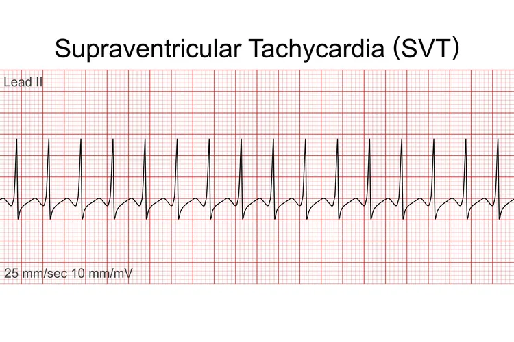 photo of Supraventricular tachycardia SVT
