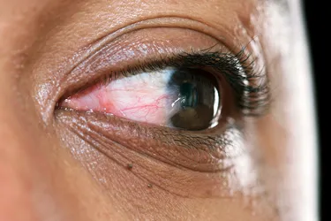 Surfer's eye or pterygium is a growth on your eye. It may be strange looking and annoying, but it's not generally dangerous. (Photo Credit: MID ESSEX HOSPITAL SERVICES NHS TRUST/Science Source)