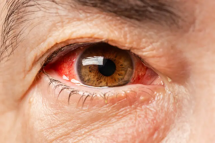 photo of red blood eye of mature adult 
