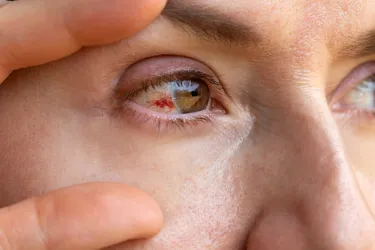 Does a burst blood vessel in your eye (subconjunctival hemorrhage) mean you have high blood pressure? Not necessarily. Most burst vessels are harmless. But if this happens repeatedly, check with your doctor. (Photo Credit: iStock/Getty Images)