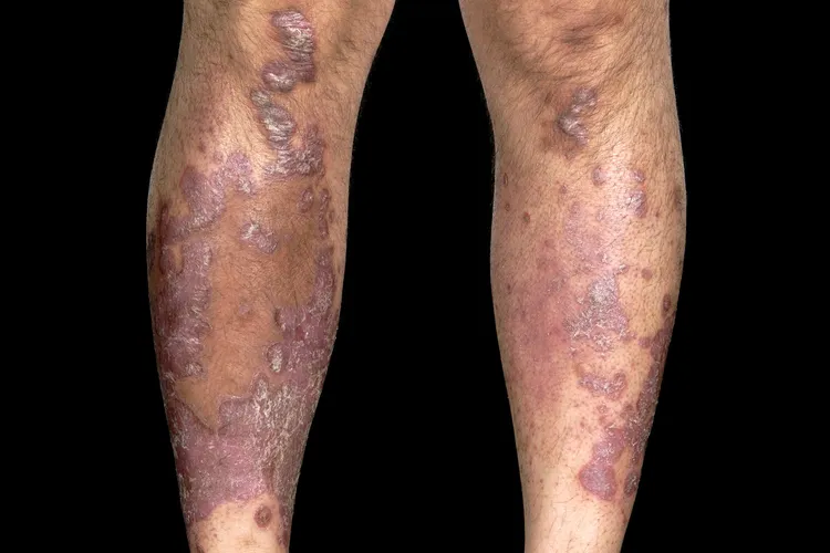 photo of psoriatic arthritis on man's legs