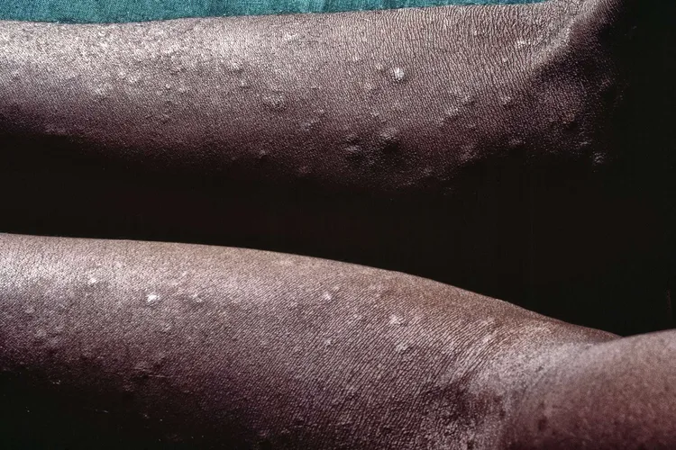 photo of syphilis rash on arms