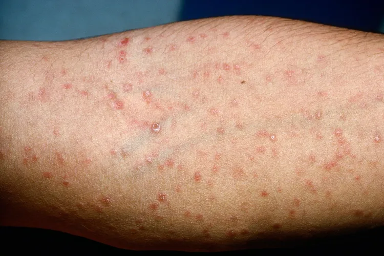 photo of syphilis rash on leg