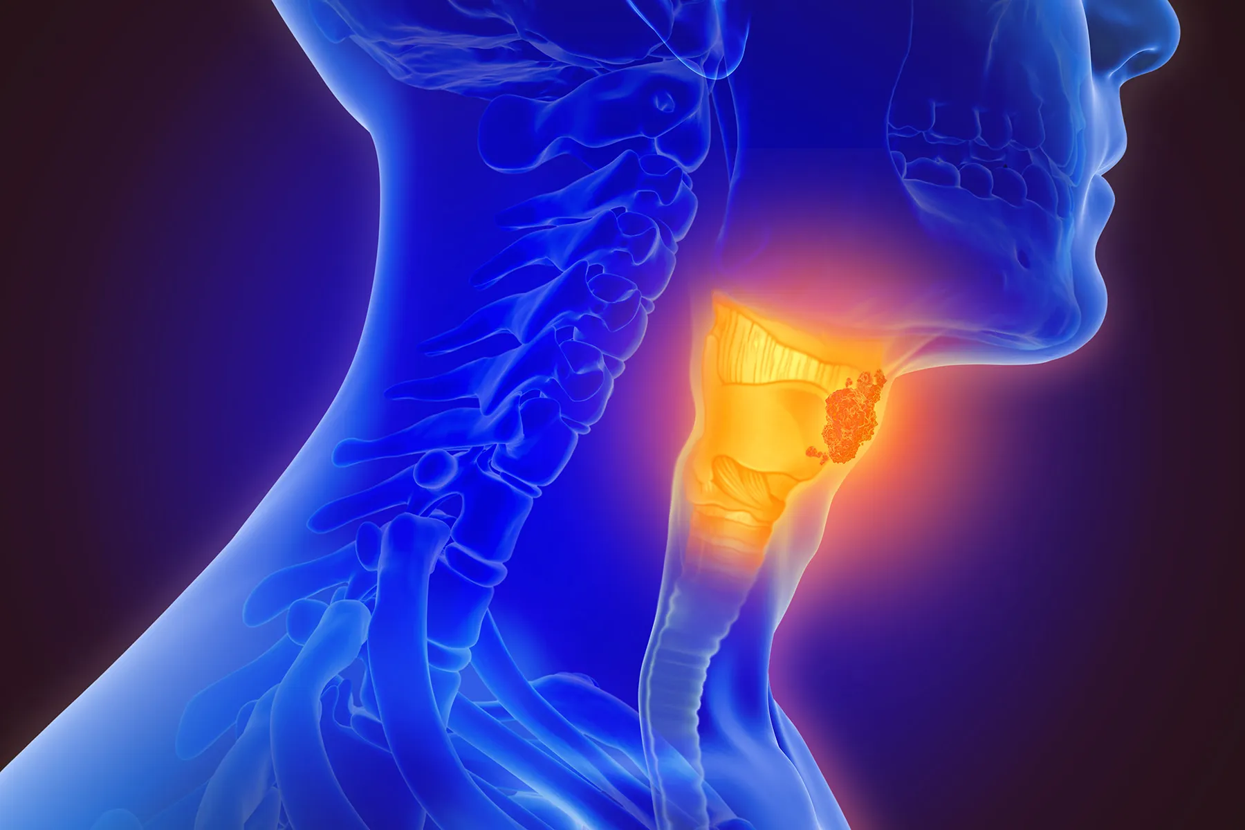 photo of throat cancer