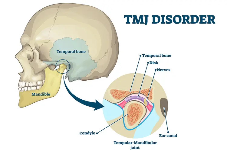 photo of tmj disorder