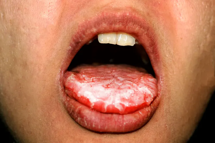 photo of Tongue thrush