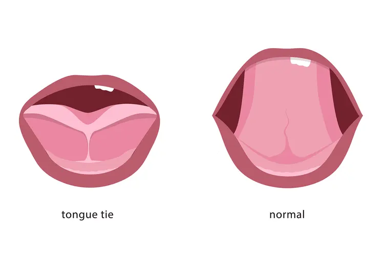 photo of Tongue tie
