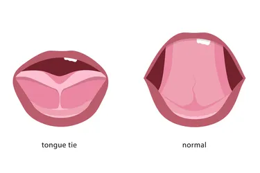 With tongue-tie, an unusually short, thick, or tight band of tissue (lingual frenulum) tethers the tip of the tongue to the floor of the mouth. (Photo credit: Maryna Vladymyrska/Dreamstime)