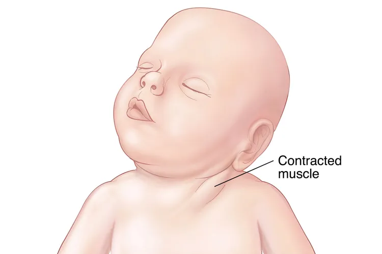 photo of congenital torticollis