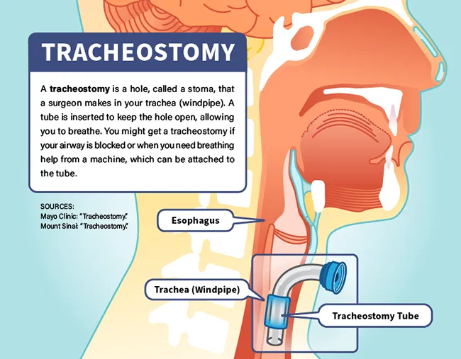 tracheostomy infographic
