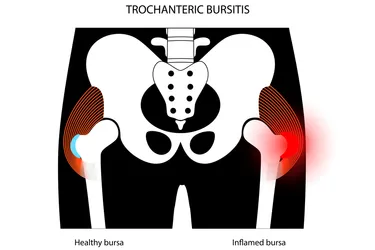 When your outside hip bursa gets inflamed, you have trochanteric bursitis. (Photo credit: Tetiana Pavliuchenko/Dreamstime)
