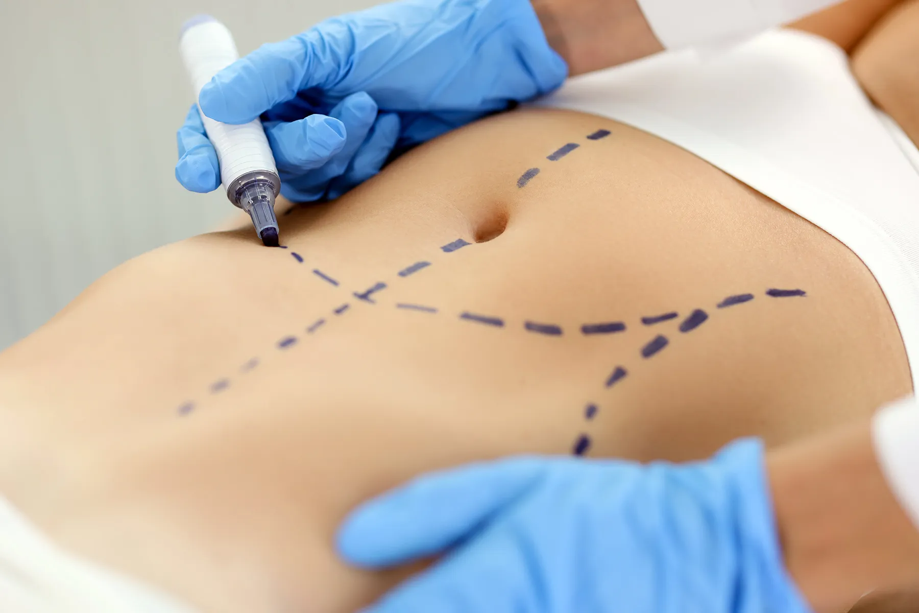 Tummy Tuck Inland Empire